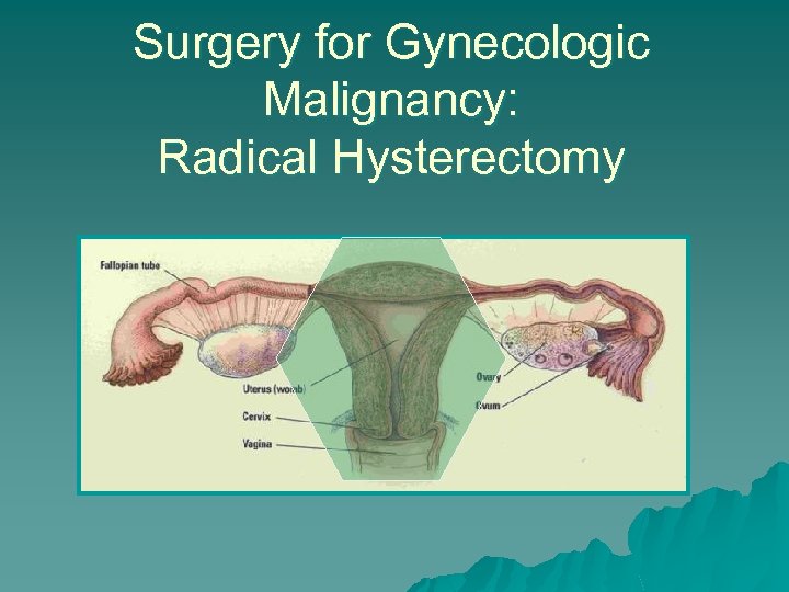 Surgery for Gynecologic Malignancy: Radical Hysterectomy 