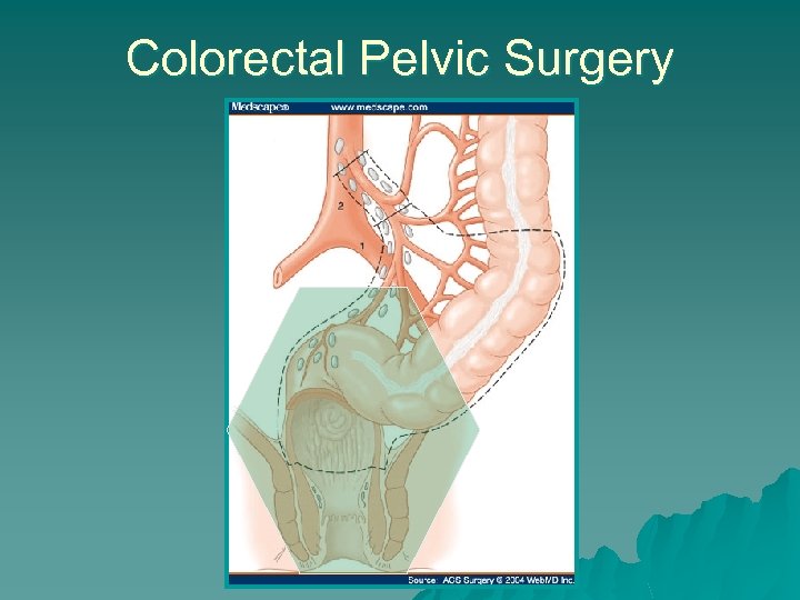Colorectal Pelvic Surgery 