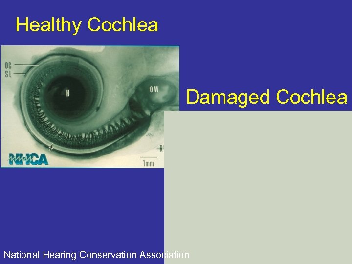 Healthy Cochlea Damaged Cochlea National Hearing Conservation Association 