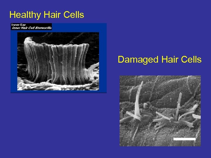 Healthy Hair Cells Damaged Hair Cells 