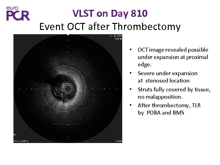 VLST on Day 810 Event OCT after Thrombectomy • OCT image revealed possible under