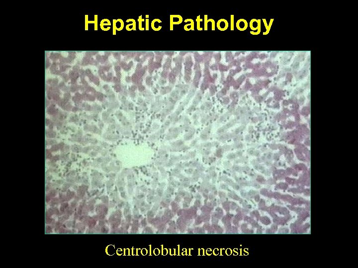 Hepatic Pathology Centrolobular necrosis 