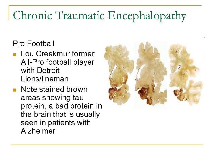 Chronic Traumatic Encephalopathy Pro Football n Lou Creekmur former All-Pro football player with Detroit