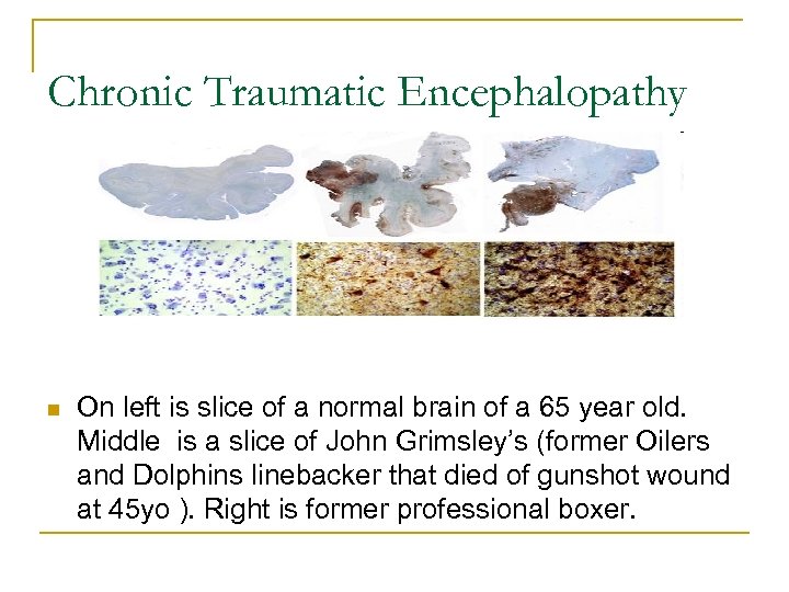 Chronic Traumatic Encephalopathy n On left is slice of a normal brain of a