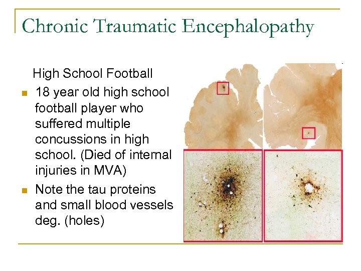 Chronic Traumatic Encephalopathy n n High School Football 18 year old high school football