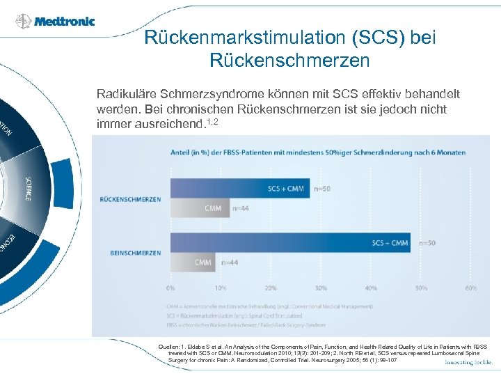 Rückenmarkstimulation (SCS) bei Rückenschmerzen Radikuläre Schmerzsyndrome können mit SCS effektiv behandelt werden. Bei chronischen