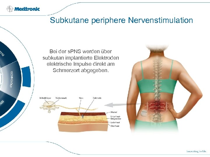 Subkutane periphere Nervenstimulation Bei der s. PNS werden über subkutan implantierte Elektroden elektrische Impulse