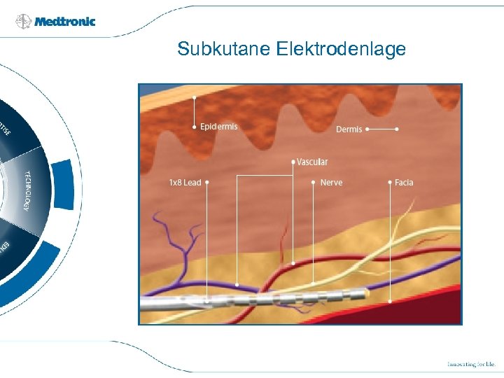 Subkutane Elektrodenlage 