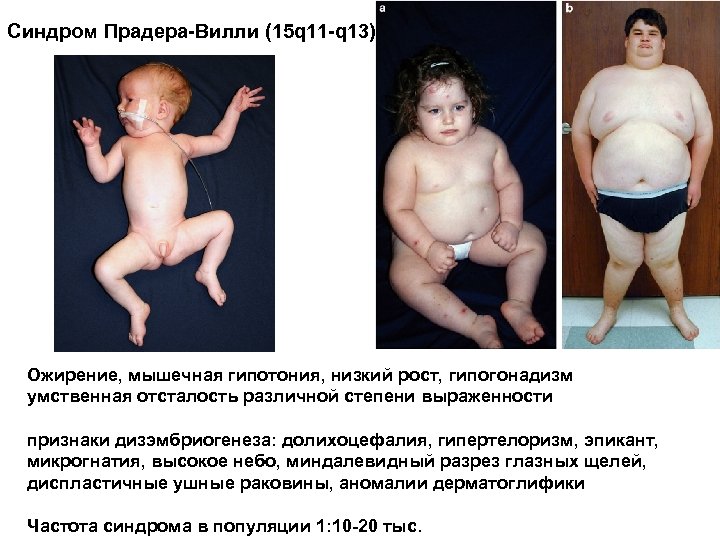 Синдром Прадера-Вилли (15 q 11 -q 13) Ожирение, мышечная гипотония, низкий рост, гипогонадизм умственная