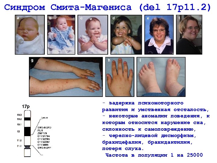 Синдром Смита-Магениса (del 17 р11. 2) - задержка психомоторного развития и умственная отсталость, -