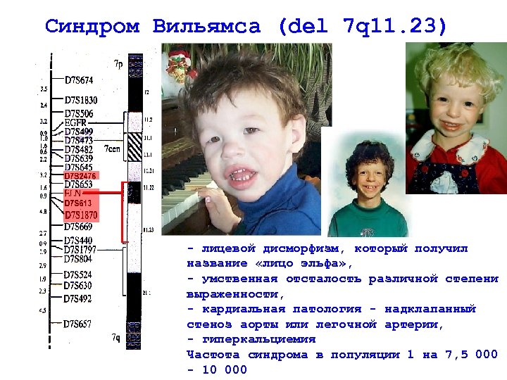 Синдром вильямса фото новорожденных