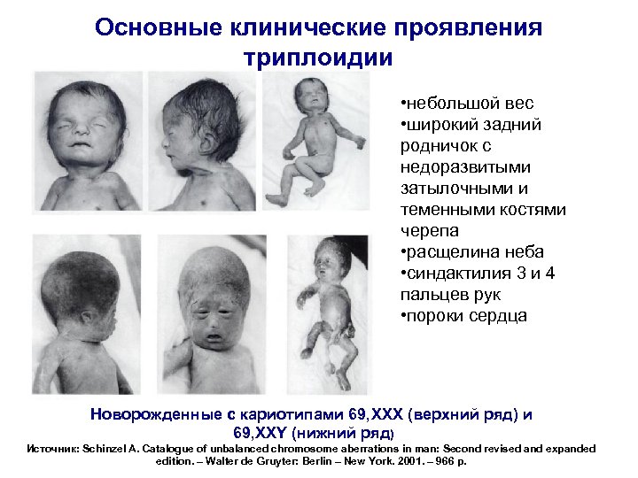 Основные клинические проявления триплоидии • небольшой вес • широкий задний родничок с недоразвитыми затылочными