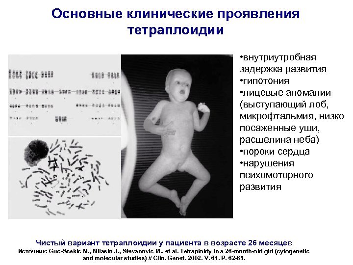 Основные клинические проявления тетраплоидии • внутриутробная задержка развития • гипотония • лицевые аномалии (выступающий