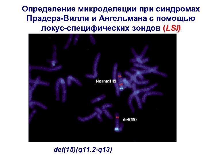 Определение микроделеции при синдромах Прадера-Вилли и Ангельмана с помощью локус-специфических зондов (LSI) del(15)(q 11.