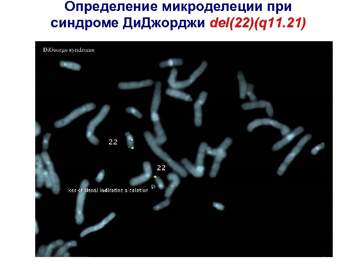 Определение микроделеции при синдроме Ди. Джорджи del(22)(q 11. 21) 