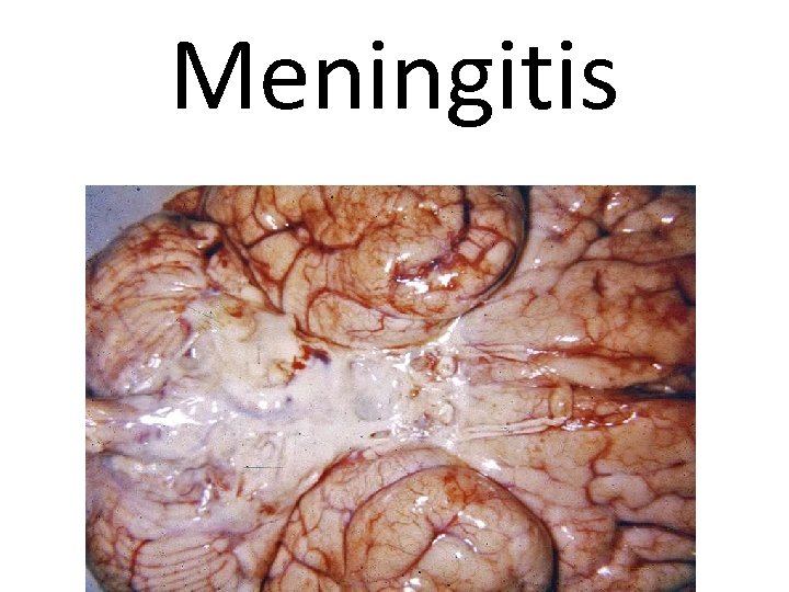 Meningitis 