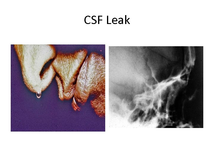 CSF Leak 