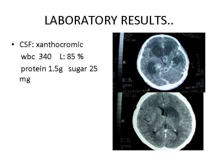 LABORATORY RESULTS. . • CSF: xanthocromic wbc 340 L: 85 % protein 1. 5