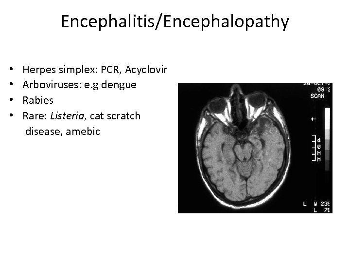 Encephalitis/Encephalopathy • • Herpes simplex: PCR, Acyclovir Arboviruses: e. g dengue Rabies Rare: Listeria,