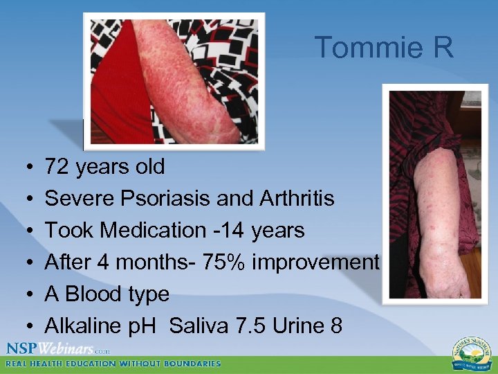 Tommie R • • • 72 years old Severe Psoriasis and Arthritis Took Medication