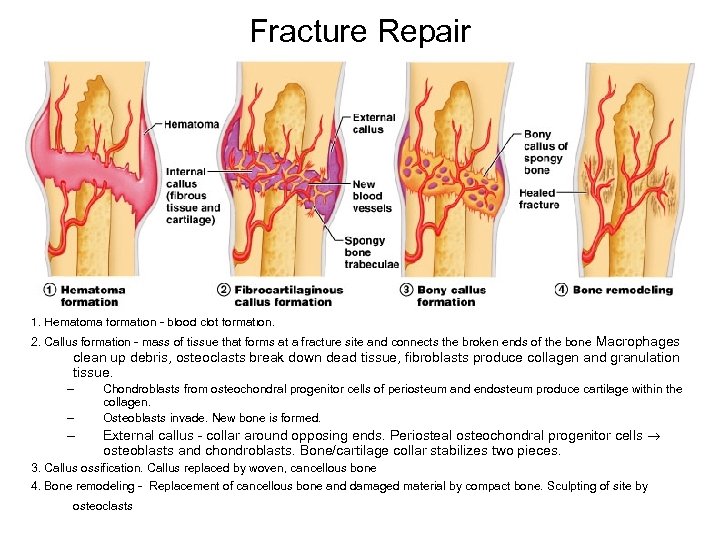 Fracture Repair 1. Hematoma formation - blood clot formation. 2. Callus formation - mass