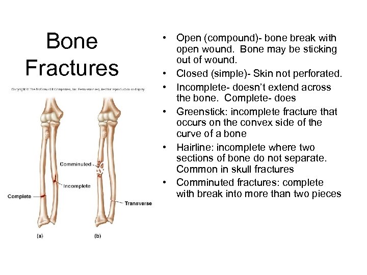Bone Fractures • Open (compound)- bone break with open wound. Bone may be sticking