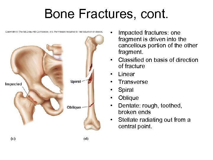 Bone Fractures, cont. • Impacted fractures: one fragment is driven into the cancellous portion
