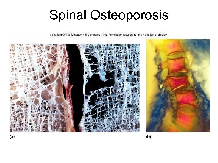 Spinal Osteoporosis 