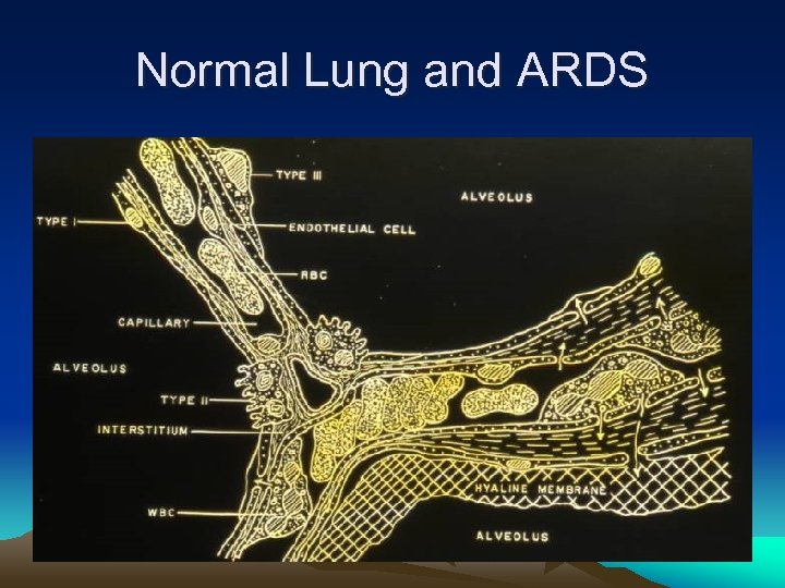 Normal Lung and ARDS 