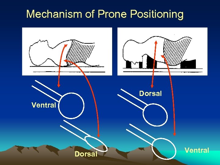 Mechanism of Prone Positioning Dorsal Ventral 