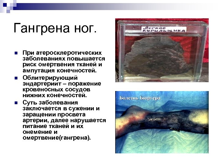 Гангрена ног. n n n При атеросклеротических заболеваниях повышается риск омертвения тканей и ампутация