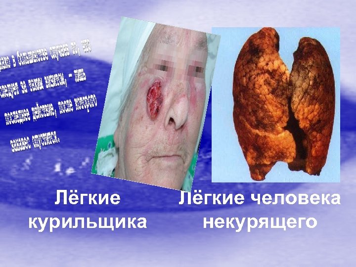 Лёгкие курильщика Лёгкие человека некурящего 