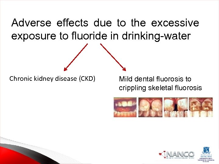 Adverse effects due to the excessive exposure to fluoride in drinking-water Chronic kidney disease