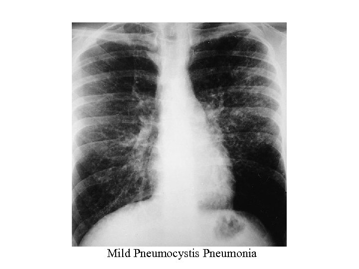 Mild Pneumocystis Pneumonia 