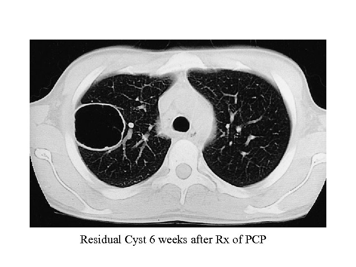 Residual Cyst 6 weeks after Rx of PCP 