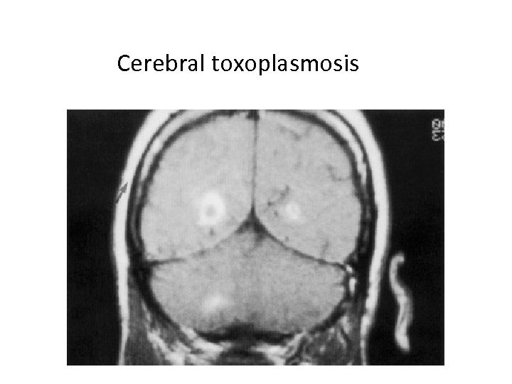 Cerebral toxoplasmosis 