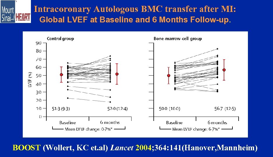 Intracoronary Autologous BMC transfer after MI: Global LVEF at Baseline and 6 Months Follow-up.