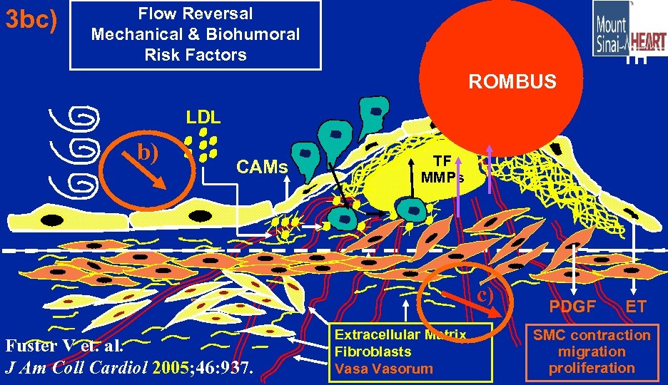 3 bc) Flow Reversal Mechanical & Biohumoral Risk Factors TH ROMBUS LDL b) CAMs