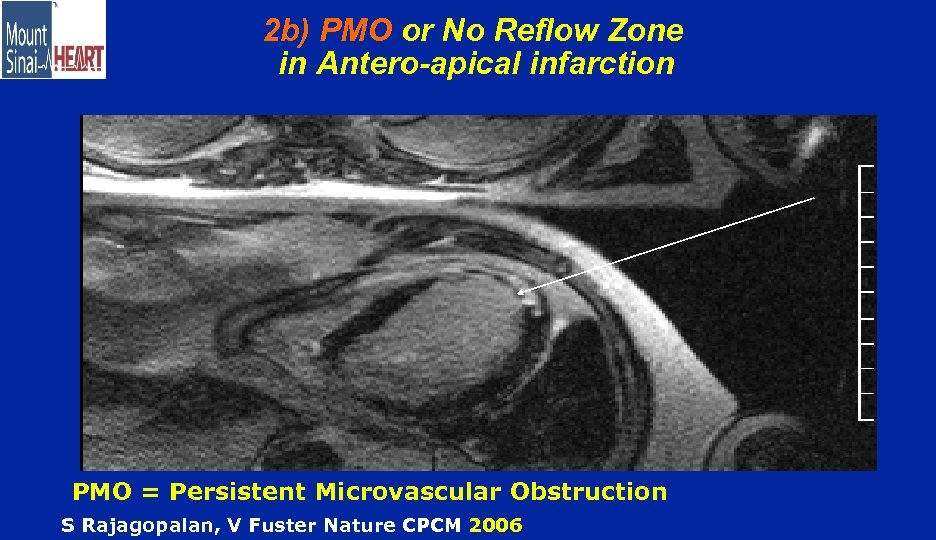 2 b) PMO or No Reflow Zone in Antero-apical infarction PMO = Persistent Microvascular