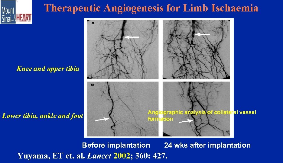Therapeutic Angiogenesis for Limb Ischaemia Knee and upper tibia Lower tibia, ankle and foot