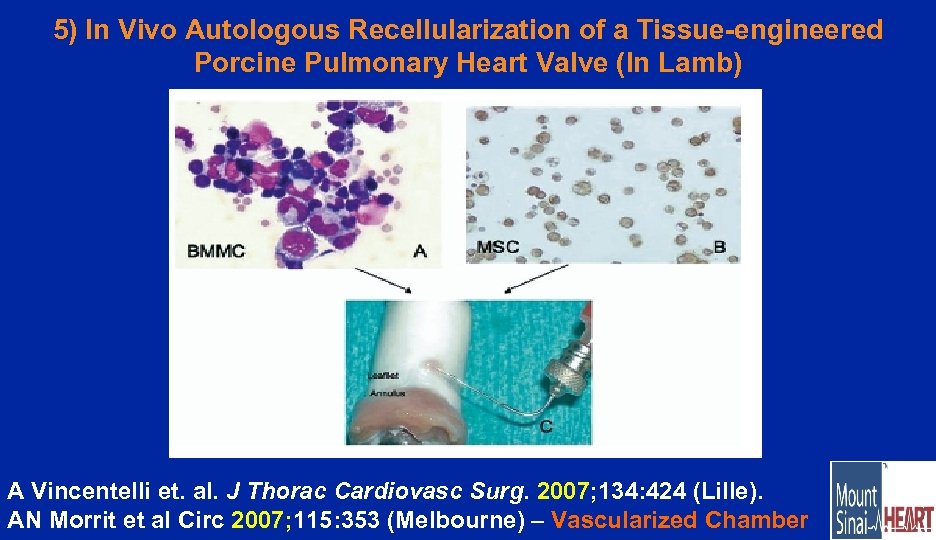 5) In Vivo Autologous Recellularization of a Tissue-engineered Porcine Pulmonary Heart Valve (In Lamb)