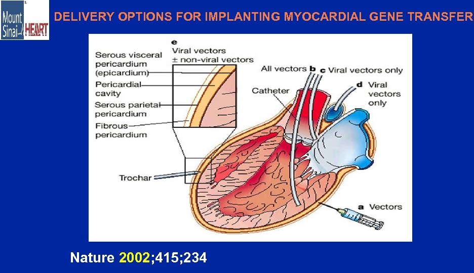 DELIVERY OPTIONS FOR IMPLANTING MYOCARDIAL GENE TRANSFER Nature 2002; 415; 234 