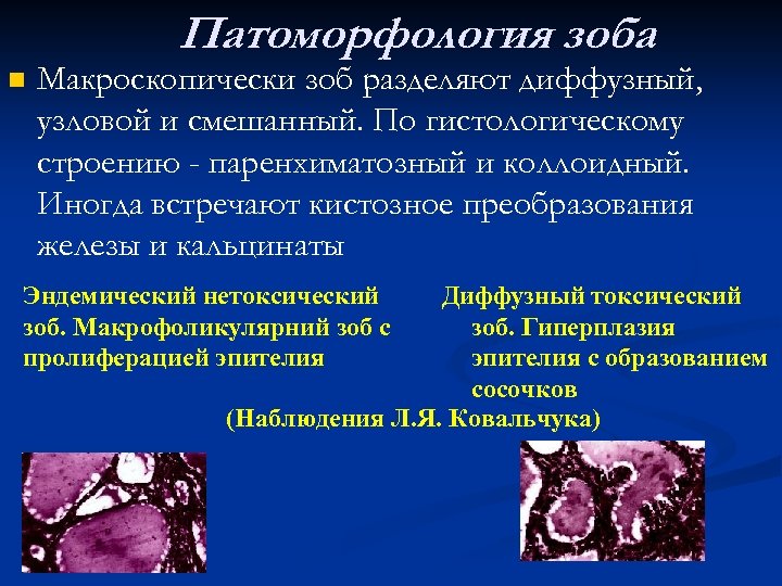 Патоморфология зоба n Макроскопически зоб разделяют диффузный, узловой и смешанный. По гистологическому строению -