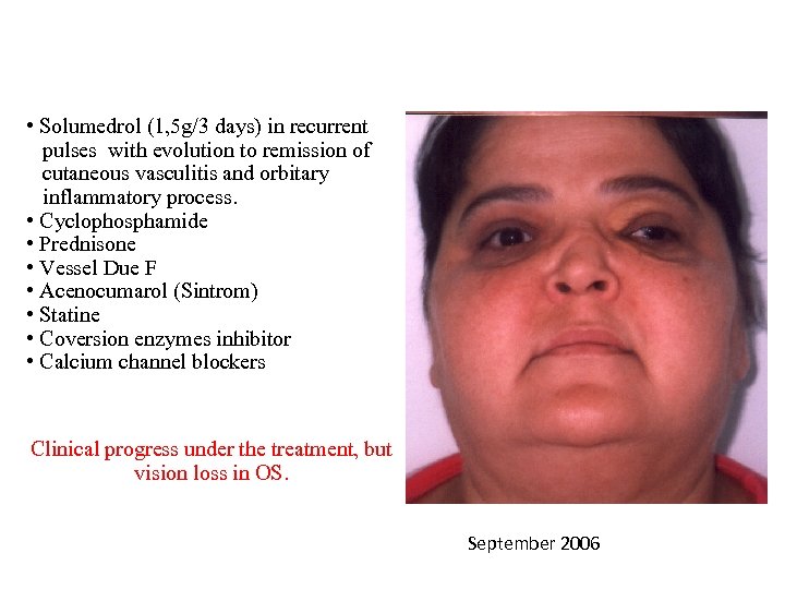  • Solumedrol (1, 5 g/3 days) in recurrent pulses with evolution to remission