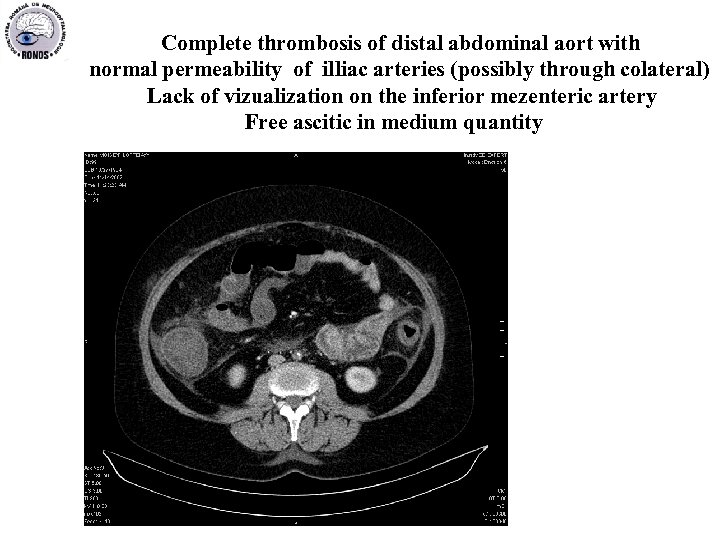  Complete thrombosis of distal abdominal aort with normal permeability of illiac arteries (possibly