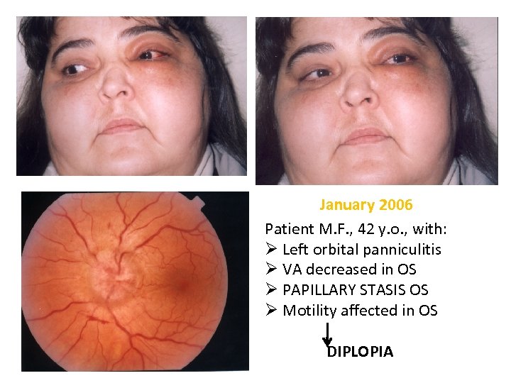 January 2006 Patient M. F. , 42 y. o. , with: Ø Left orbital