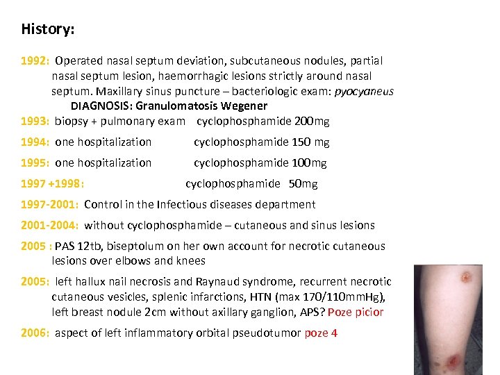 History: 1992: Operated nasal septum deviation, subcutaneous nodules, partial nasal septum lesion, haemorrhagic lesions