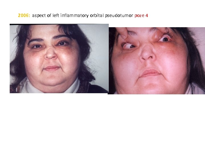 2006: aspect of left inflammatory orbital pseudotumor poze 4 