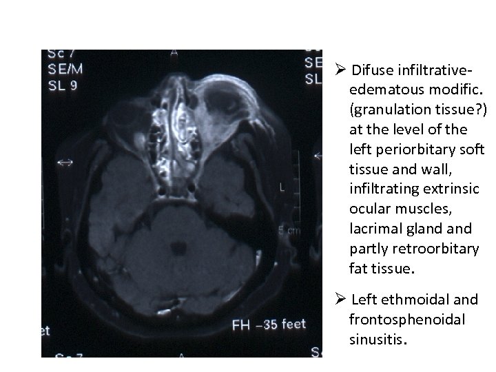 Ø Difuse infiltrative- edematous modific. (granulation tissue? ) at the level of the left