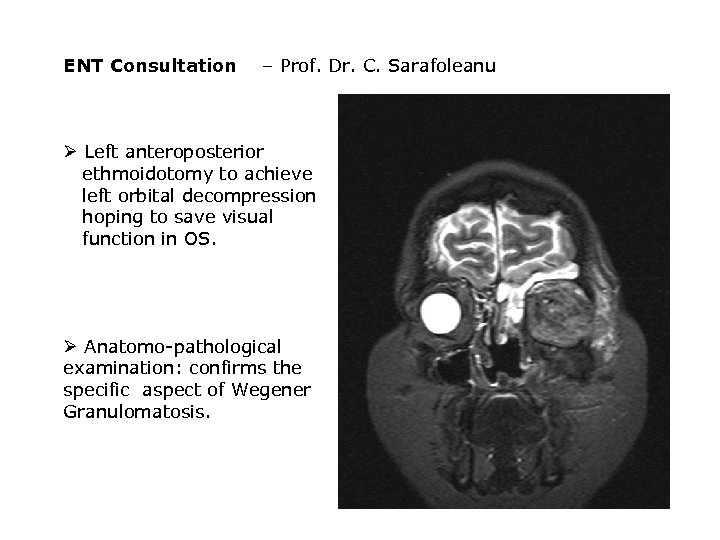 ENT Consultation – Prof. Dr. C. Sarafoleanu Ø Left anteroposterior ethmoidotomy to achieve left